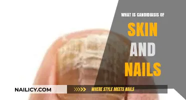 Understanding Candidiasis: Skin and Nail Fungal Infections Explained