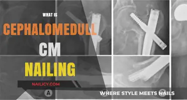 Understanding Cephalomedullary CM Nailing: A Comprehensive Surgical Technique Guide