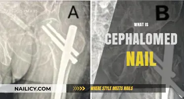 Understanding Cephalomedullary Nails: Advanced Femur Fracture Treatment Explained