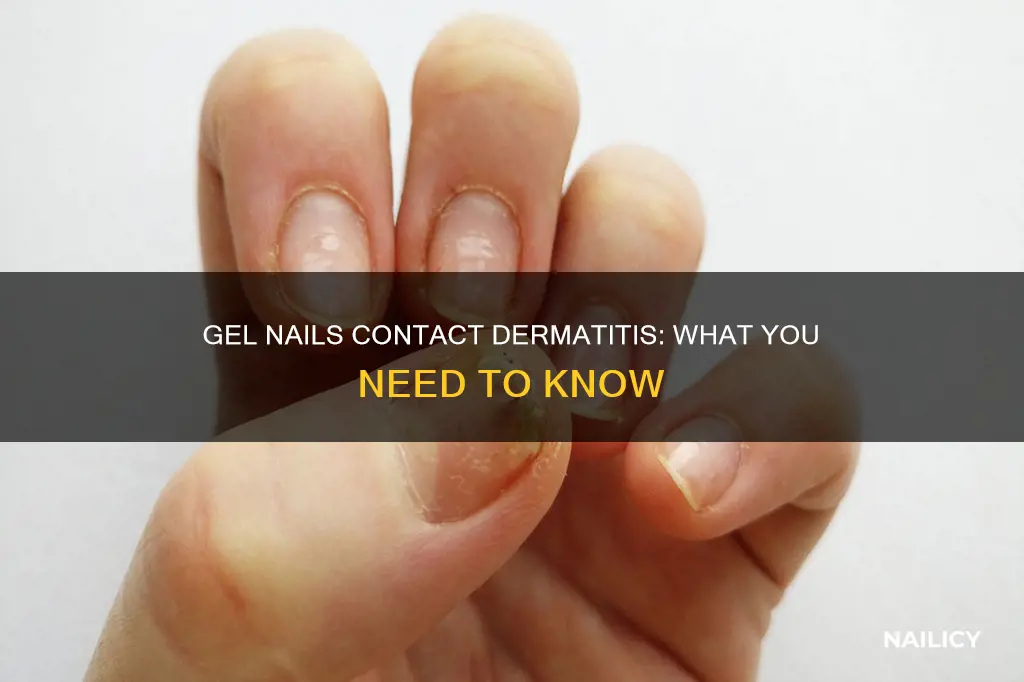 what is contact dermatitis from gel nails