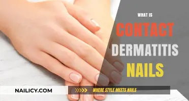 Understanding Contact Dermatitis Nails: Causes, Symptoms, and Treatment Options