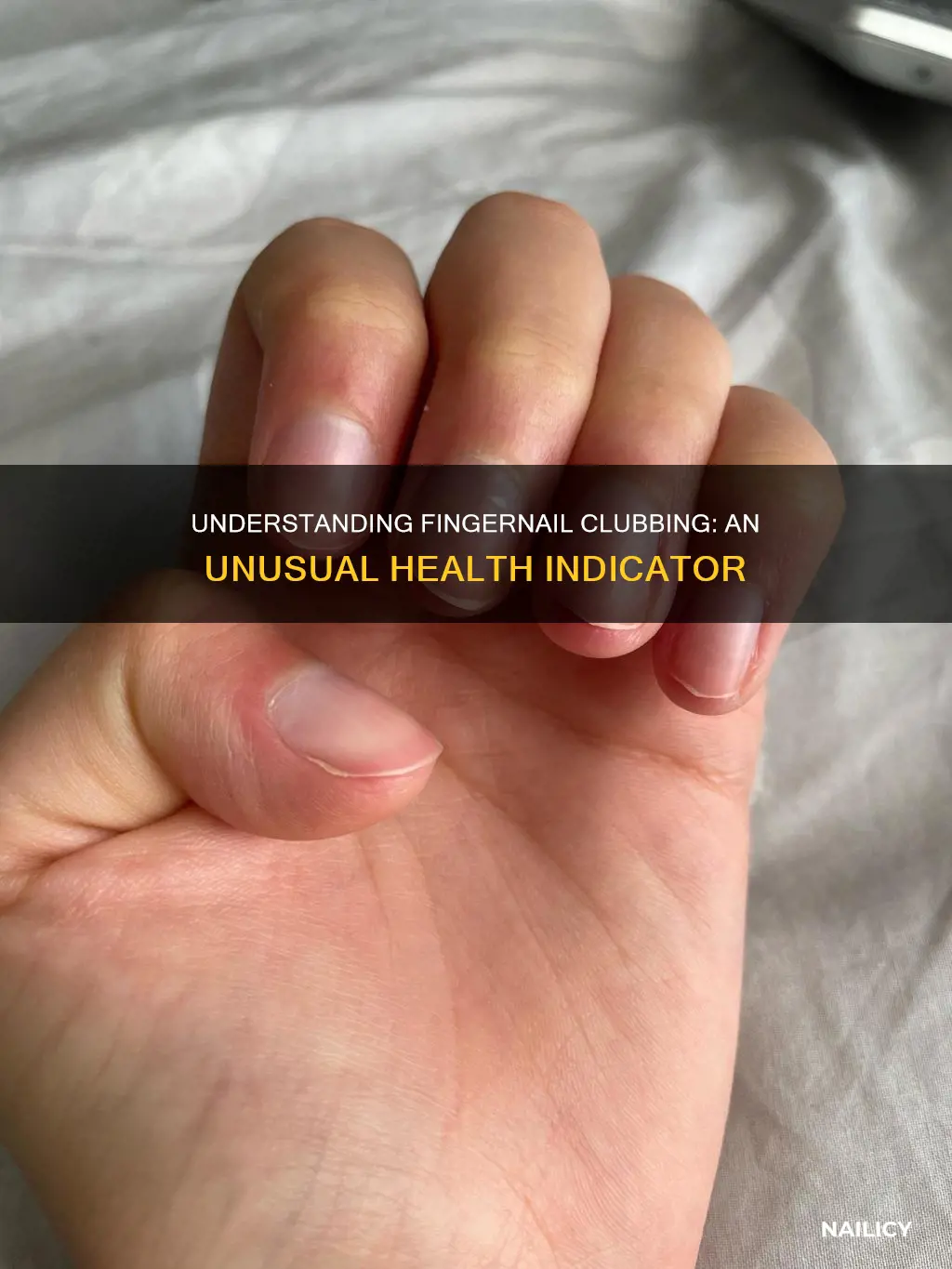 what is finger nail clubbing