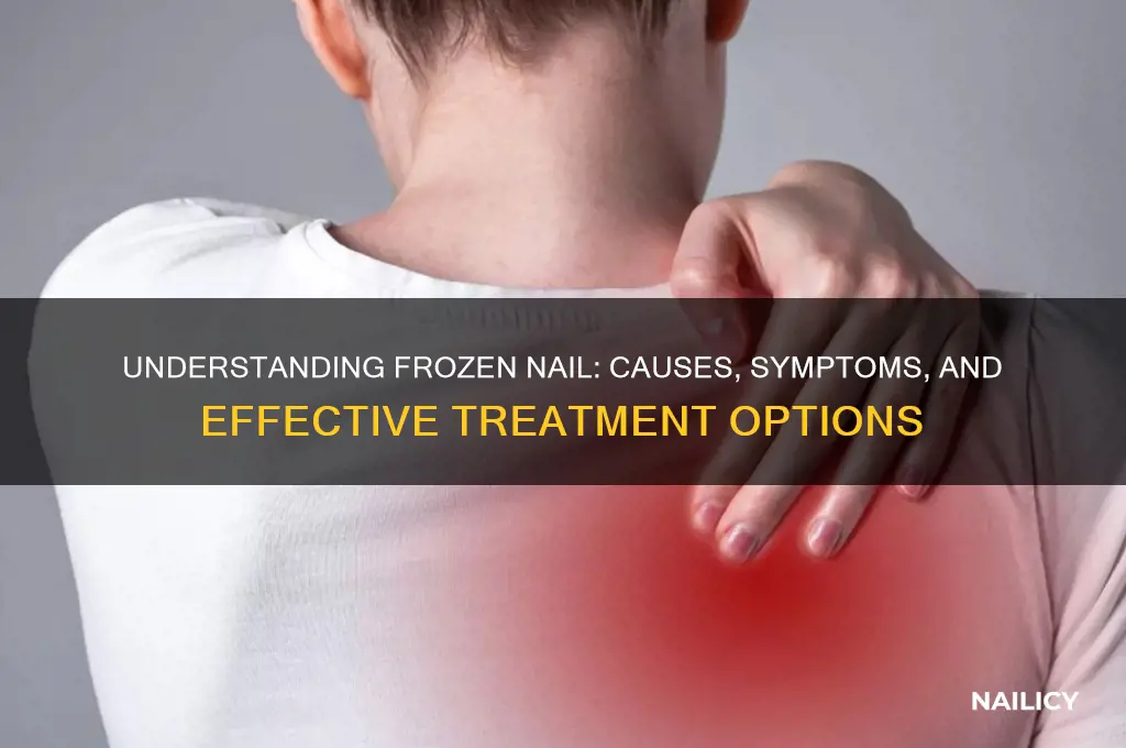 what is frozen nail