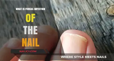 Understanding Fungal Nail Infections: Causes, Symptoms, and Treatment Options