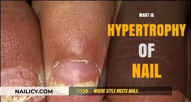 Understanding Hypertrophy of the Nail: Causes, Symptoms, and Treatment Options