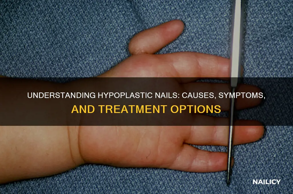 what is hypoplastic nails