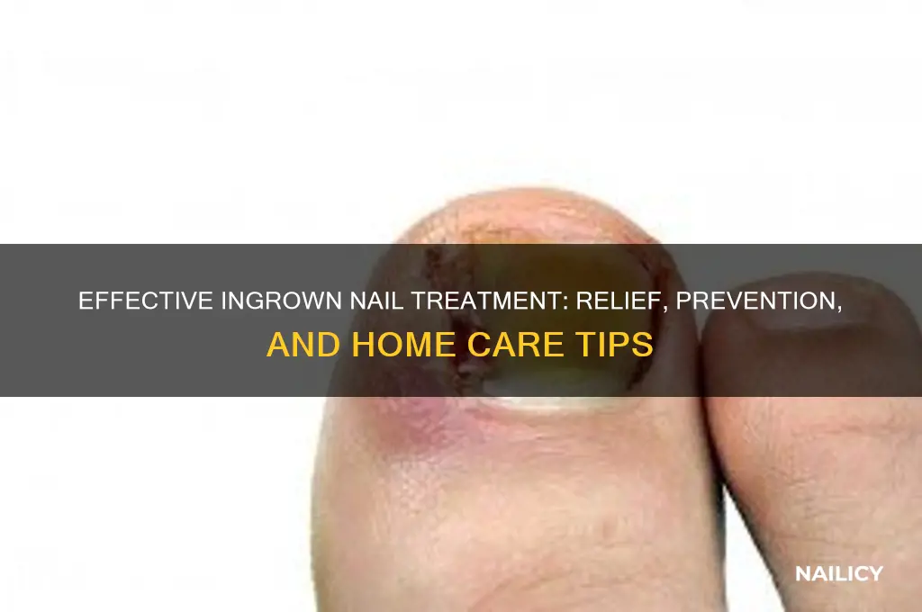 what is ingrown nail treatment