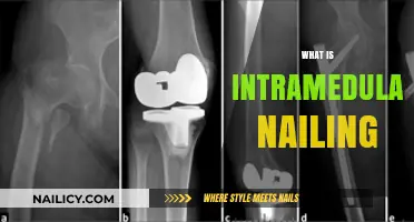 Understanding Intramedullary Nailing: A Comprehensive Guide to Bone Fracture Repair