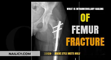 Understanding Intramedullary Nailing for Femur Fracture Treatment and Recovery