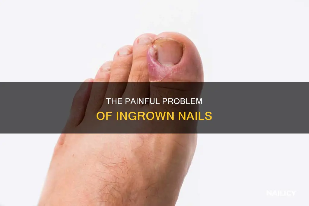 what is it called when nail grows into finger