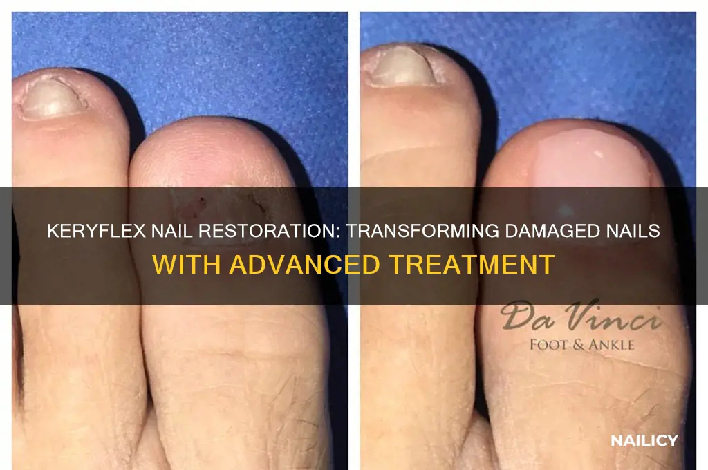 what is keryflex nail restoration