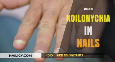 Understanding Koilonychia: Causes, Symptoms, and Treatment for Spoon Nails