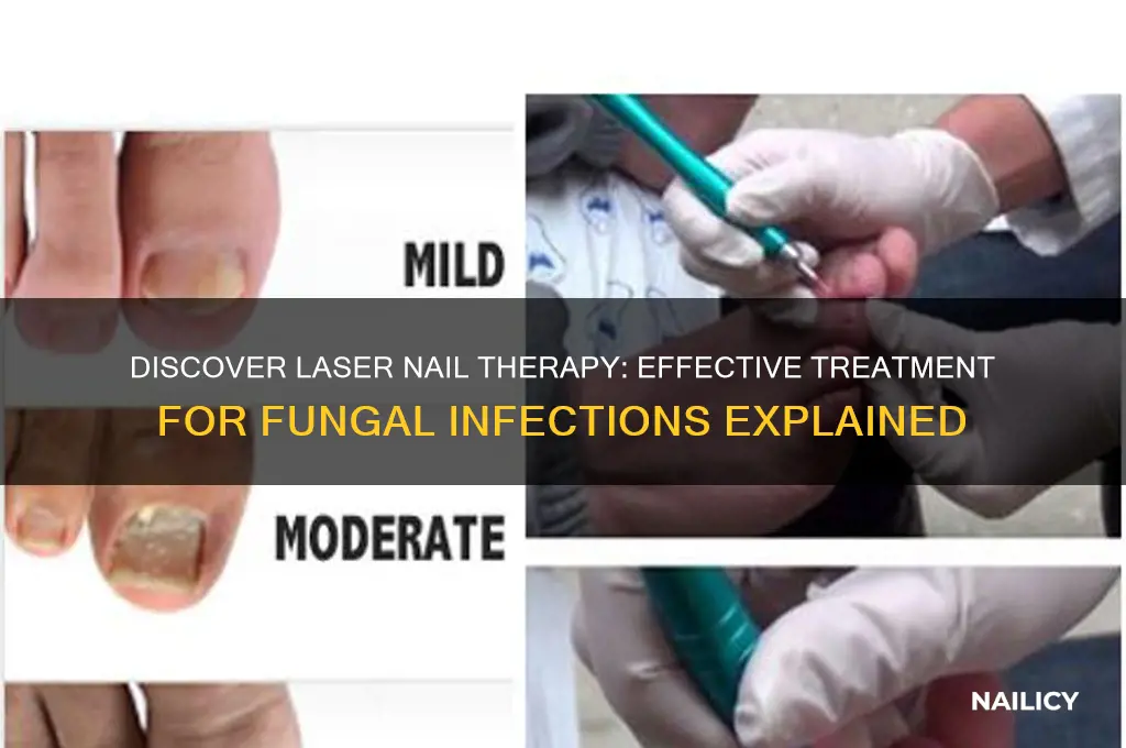 what is laser nail therapy