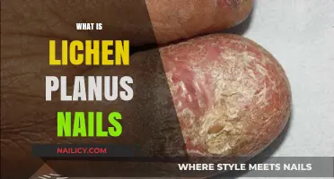 Understanding Lichen Planus: Nail Symptoms, Causes, and Treatment Options