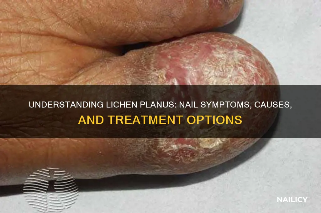 what is lichen planus nails