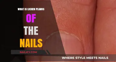 Understanding Lichen Planus: Nail Symptoms, Causes, and Treatment Options