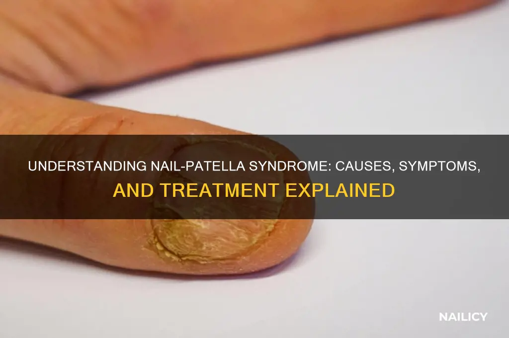 what is meant by nail-patella syndrome