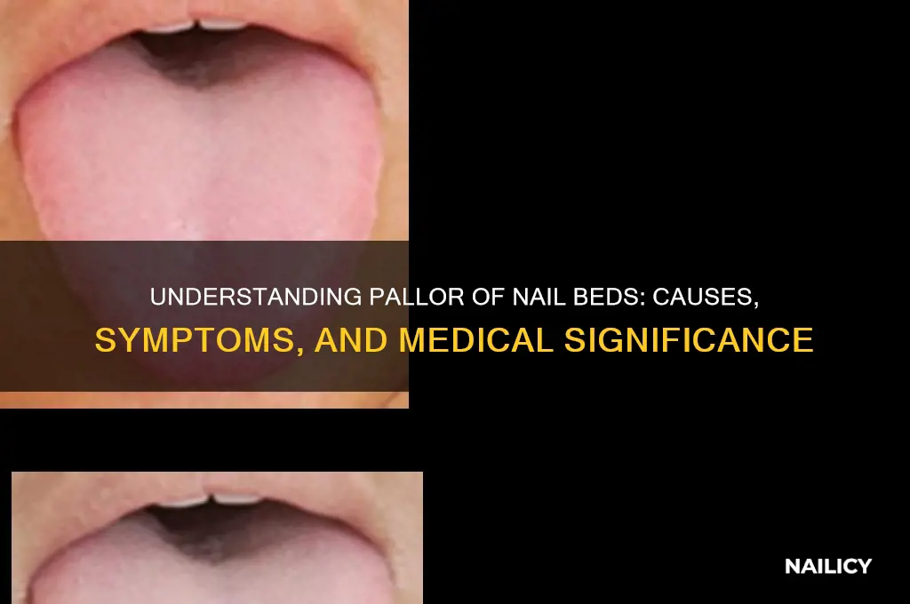 what is meant bypallor of nail beds