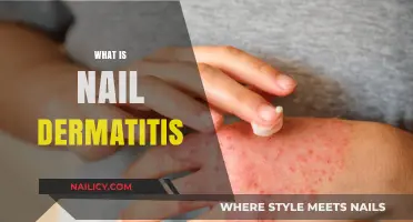 Understanding Nail Dermatitis: Causes, Symptoms, and Effective Treatment Options