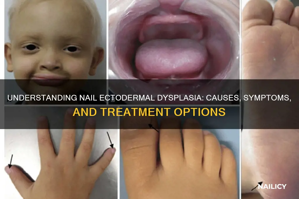 what is nail ectodermal dysplasia
