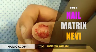 Understanding Nail Matrix Nevi: Causes, Symptoms, and Treatment Options