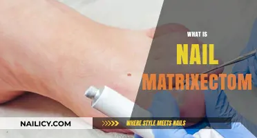 Understanding Nail Matrixectomy: Procedure, Benefits, and Recovery Explained
