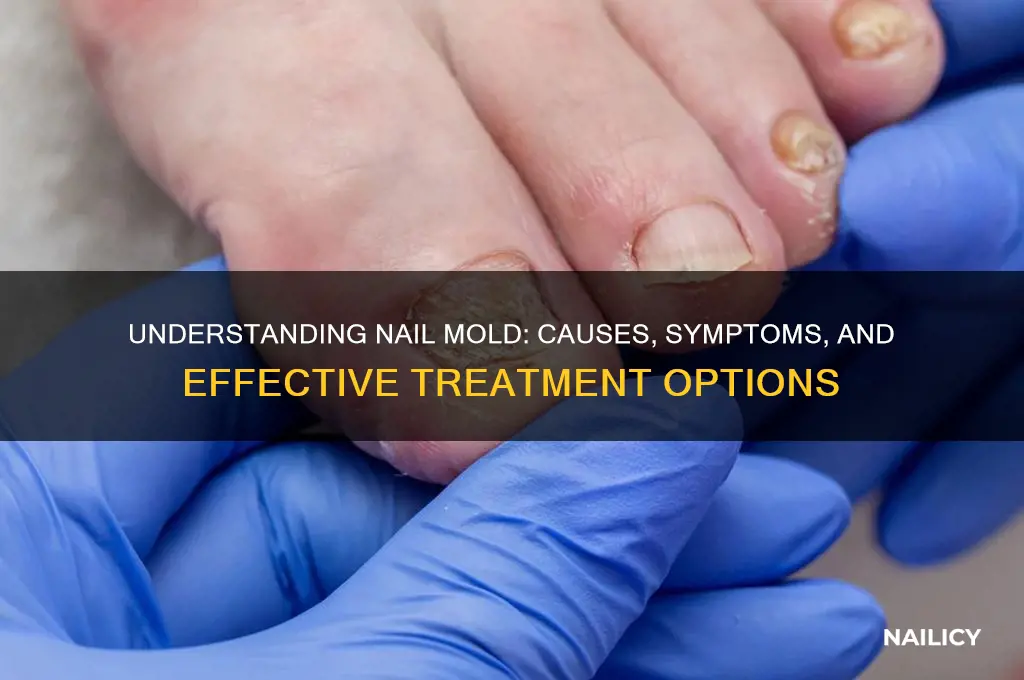 what is nail mold
