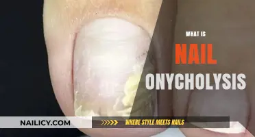 Understanding Nail Onycholysis: Causes, Symptoms, and Effective Treatment Options