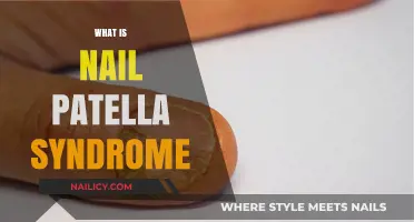 Understanding Nail Patella Syndrome: Causes, Symptoms, and Treatment Options