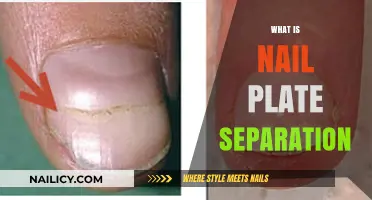 Understanding Nail Plate Separation: Causes, Symptoms, and Treatment Options
