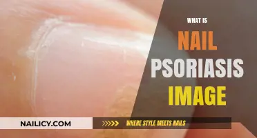 Understanding Nail Psoriasis: Visual Guide to Symptoms and Treatment