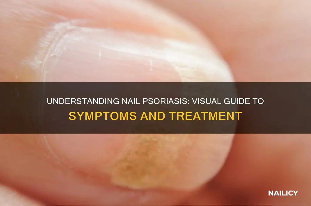 what is nail psoriasis image