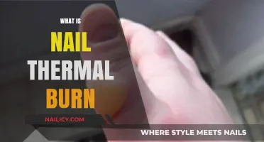 Understanding Nail Thermal Burns: Causes, Symptoms, and Prevention Tips