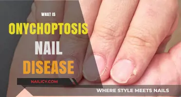 Understanding Onychoptosis: Causes, Symptoms, and Treatment for Nail Disease