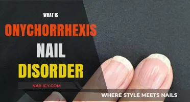 Understanding Onychorrhexis: Causes, Symptoms, and Treatment for Brittle Nails