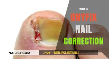 Understanding Onyfix Nail Correction: A Revolutionary Treatment for Healthy Nails