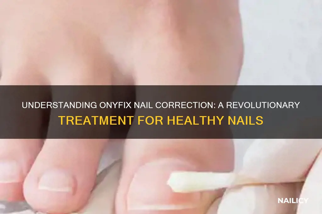 what is onyfix nail correction