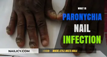 Understanding Paronychia: Causes, Symptoms, and Treatment of Nail Infections