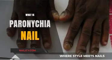 Understanding Paronychia: Causes, Symptoms, and Treatment for Nail Infections