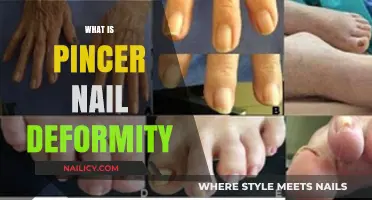 Understanding Pincer Nail Deformity: Causes, Symptoms, and Treatment Options