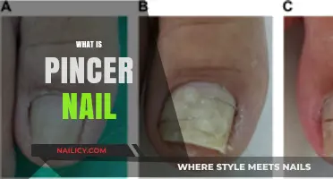 Understanding Pincer Nails: Causes, Symptoms, and Effective Treatment Options
