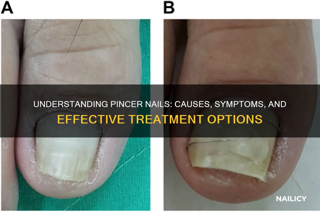 what is pincer nail