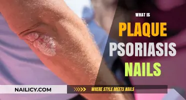 Understanding Plaque Psoriasis: Symptoms, Causes, and Nail Involvement Explained