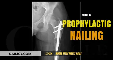 Understanding Prophylactic Nailing: Preventive Treatment for High-Risk Femoral Fractures