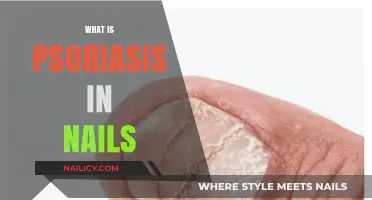 Understanding Psoriasis in Nails: Causes, Symptoms, and Treatment Options