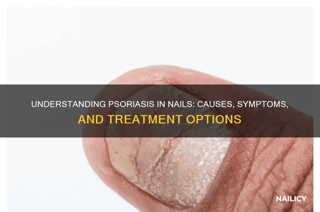 what is psoriasis in nails