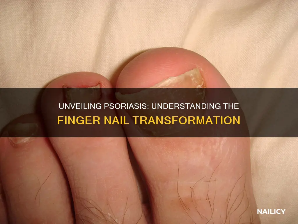 what is psoriasis of the finger nails look like