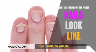 Understanding Psoriasis: Finger Nails and Their Appearance