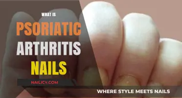 Understanding Psoriatic Arthritis Nails: Symptoms, Causes, and Treatment Options