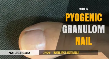 Understanding Pyogenic Granuloma: Causes, Symptoms, and Nail Treatment Options